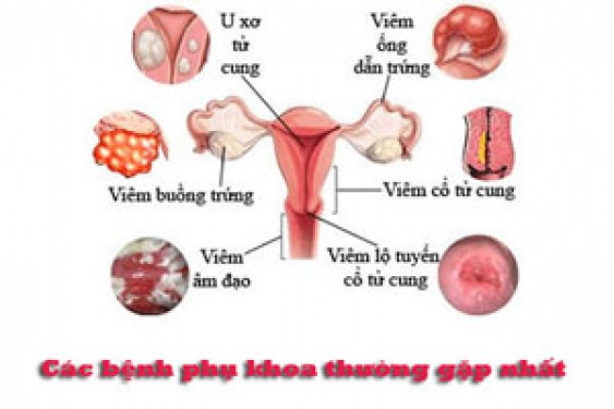 11 bệnh phụ khoa thường gặp ở phụ nữ và cách phòng ngừa