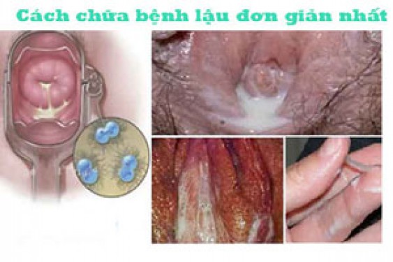 12 Cách chữa bệnh lậu đơn giản nhất tại nhà
