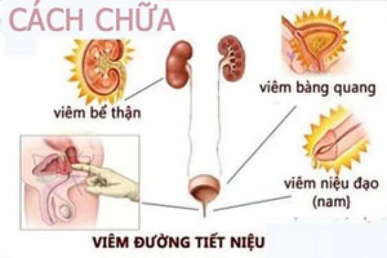 10 Cách chữa viêm đường tiết niệu hiệu quả tại nhà