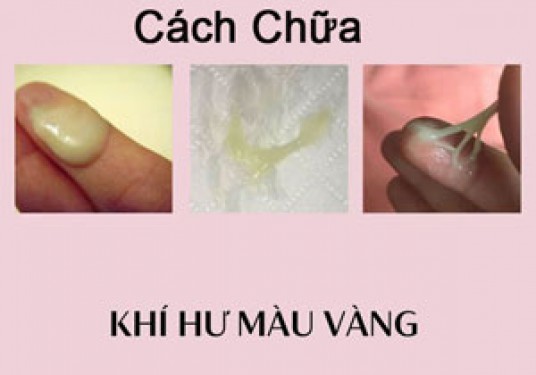 12 Cách chữa khí hư màu vàng hiệu quả tại nhà