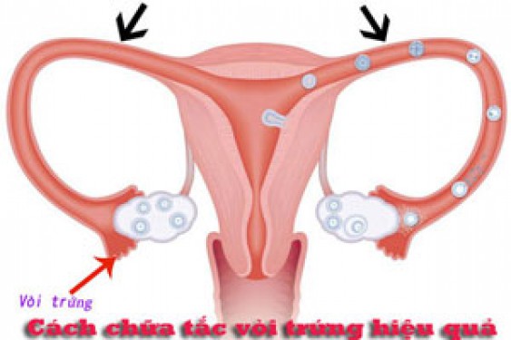 11 Cách chữa tắc vòi trứng hiệu quả tại nhà