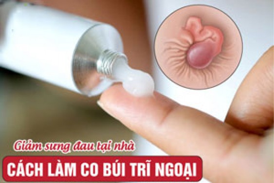 9 Cách làm co búi trĩ ngoại nhanh chóng tại nhà