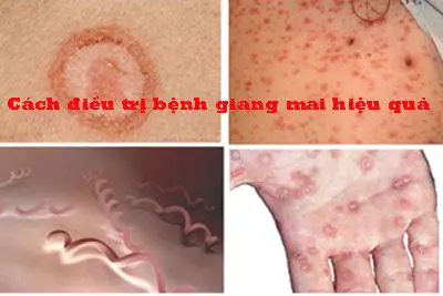 10 Cách chữa bệnh giang mai hiệu quả tại nhà