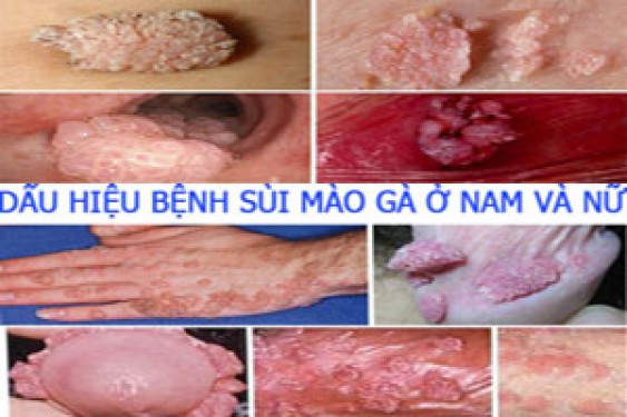 12 Dấu hiệu bệnh sùi mào gà thường gặp nhất ở nam và nữ