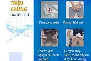 11 Dấu hiệu nhận biết bệnh trĩ nhanh nhất