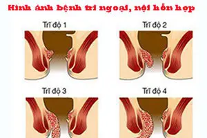 11 Hình ảnh bệnh trĩ nội, trĩ ngoại, trĩ hỗn hợp