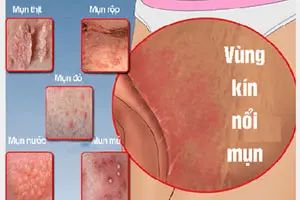 12 hình ảnh nổi mụn ở mép âm đạo cảnh báo bệnh gì?