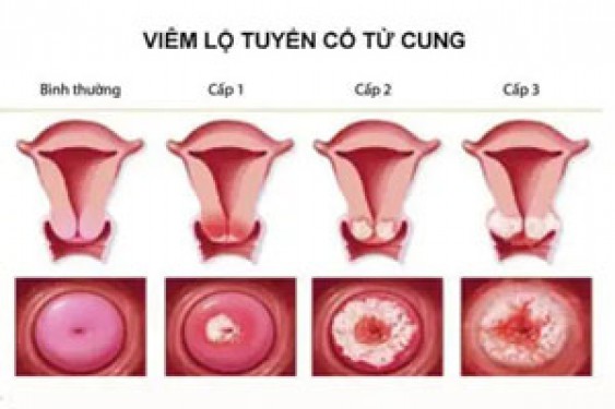 Hình ảnh viêm lộ tuyến cổ tử cung cấp độ 1,2,3,4