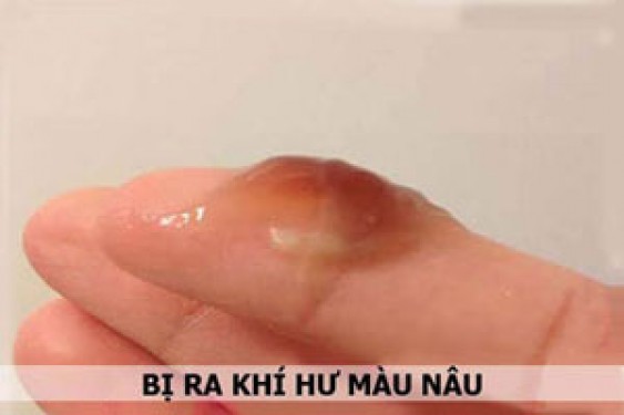 7 nguyên nhân ra khí hư ra màu nâu