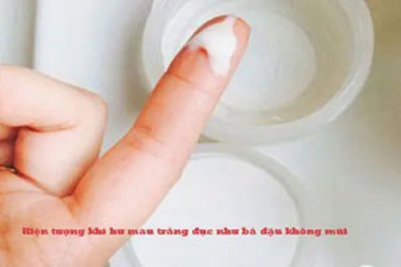 8 nguyên nhân ra khí hư ra màu trắng