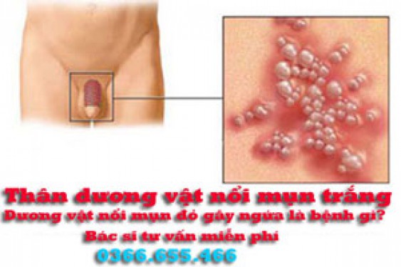 7 Nguyên nhân thân dương vật nổi mụn gây ngứa