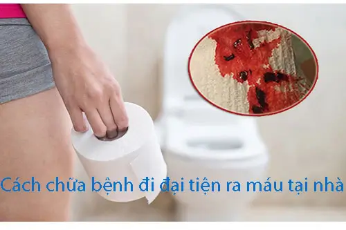 Cách chữa đi đại tiện ra máu tại nhà hiệu quả