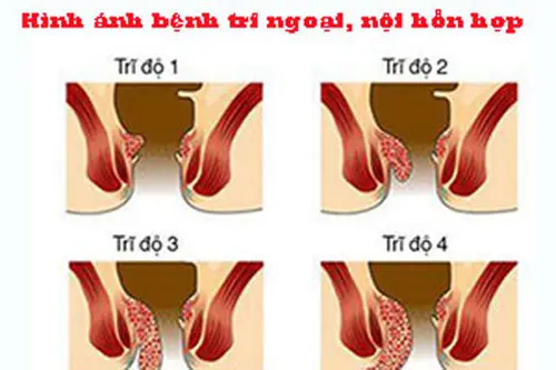 Hình ảnh bệnh trĩ ( trĩ nội, trĩ ngoại, trĩ hỗn hợp)