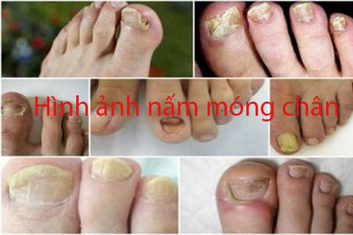 Hình ảnh nấm móng chân