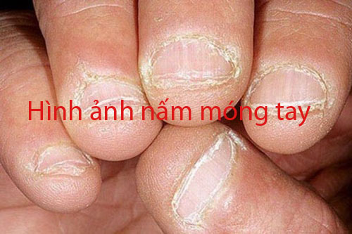 Hình ảnh nấm móng tay