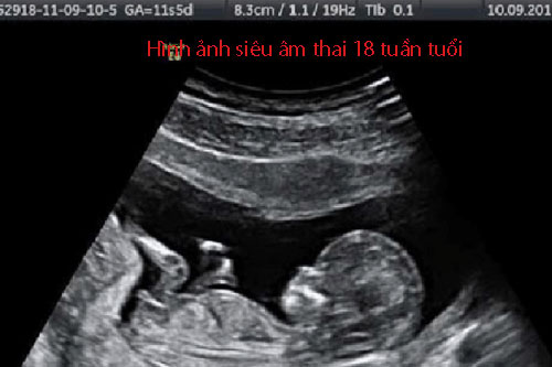 Hình ảnh siêu âm thai 18 tuần tuổi