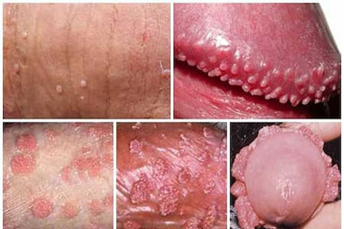 Hình ảnh bệnh sùi mào gà ở bộ phận sinh dục nam