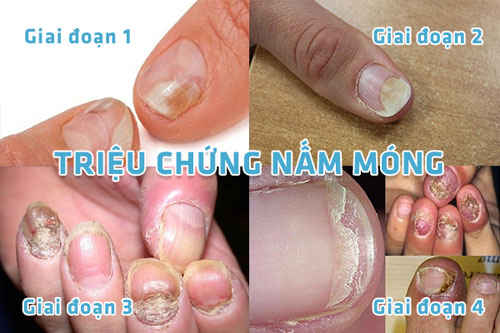 Nấm móng tay là gì