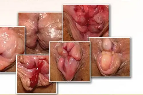 Thông tin cơ bản về bệnh trĩ